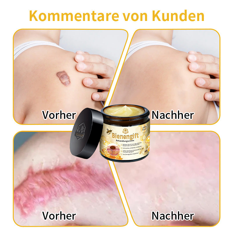 [Zusätzliche 50 % Rabatt] TLOPA® Fortgeschrittene Bienengift Behandlungscreme
