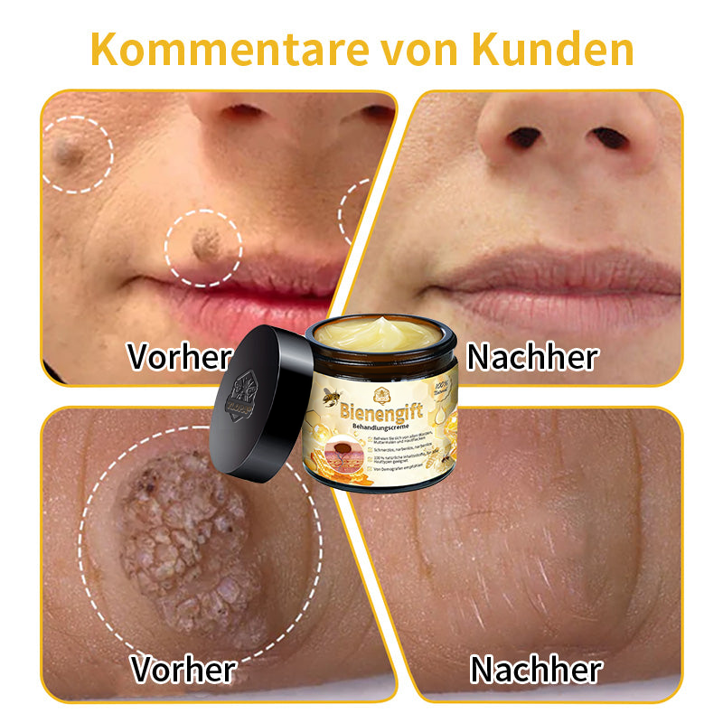 [Zusätzliche 50 % Rabatt] TLOPA® Fortgeschrittene Bienengift Behandlungscreme